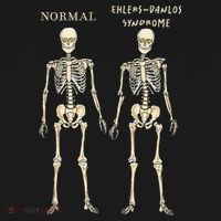 Ehlers Danlos Syndrome Skeletons Zebra Awareness Women's Hoodie thumb 2